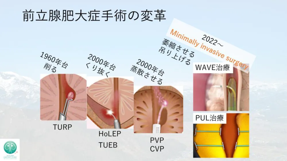 前立腺肥大症手術の変革